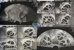 LRC助力：多囊卵巢综合征不是障碍，从不孕到三代试管婴儿的成功之路