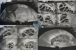 LRC助力：多囊卵巢综合征不是障碍，从不孕到三代试管婴儿的成功之路