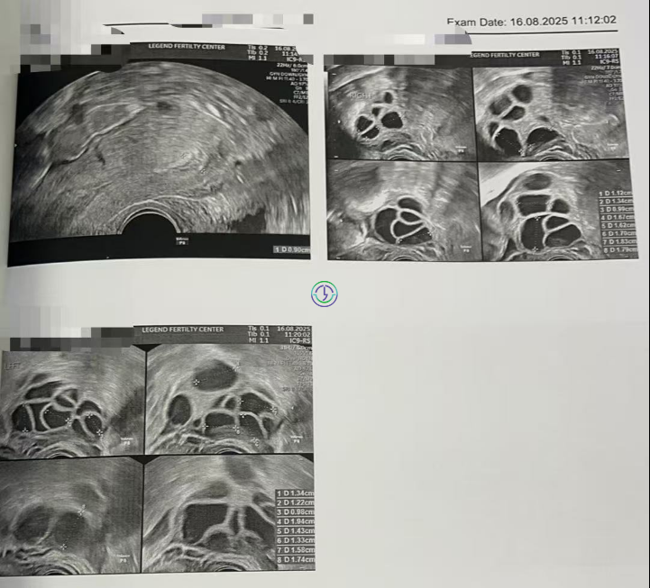 精子碎片高+卵子也长不均？LRC个性化促排+精子筛选双buff叠满，实现受精养囊百分百！