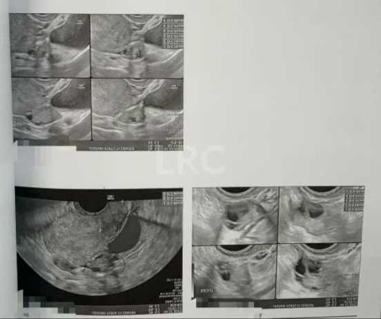 双向破局！女方40岁高龄+男方精子弱，LRC个性化方案不放弃每颗卵，5囊胚圆满收场~