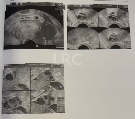 双向破局！女方40岁高龄+男方精子弱，LRC个性化方案不放弃每颗卵，5囊胚圆满收场~