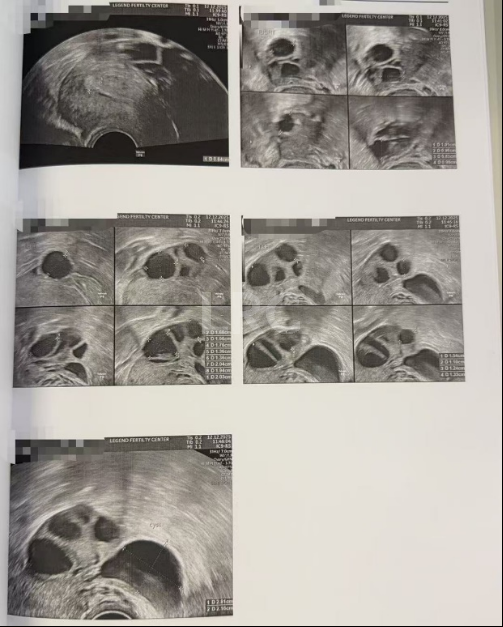 双向破局！女方40岁高龄+男方精子弱，LRC个性化方案不放弃每颗卵，5囊胚圆满收场~
