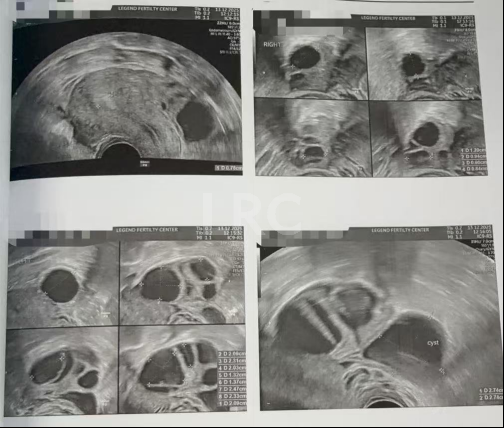 双向破局！女方40岁高龄+男方精子弱，LRC个性化方案不放弃每颗卵，5囊胚圆满收场~