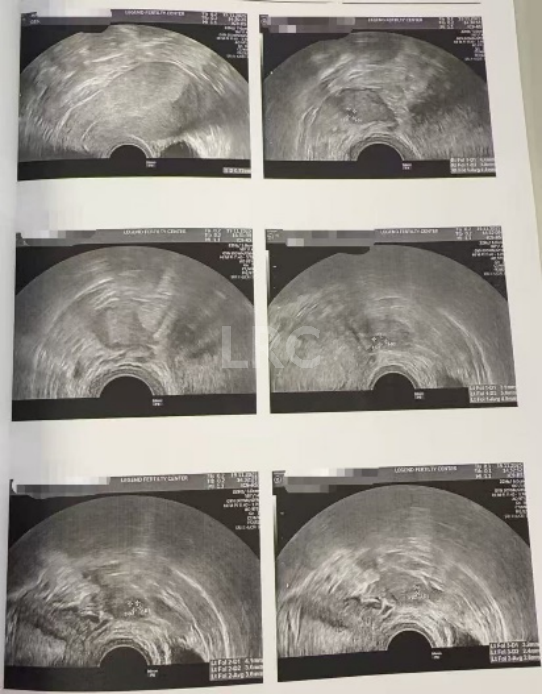 39岁卵巢差+两梯队卵泡？LRC分阶连续促排全力挽救小卵泡，6枚囊胚逆袭好孕！