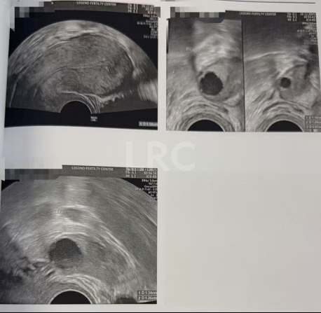 39岁卵巢差+两梯队卵泡？LRC分阶连续促排全力挽救小卵泡，6枚囊胚逆袭好孕！