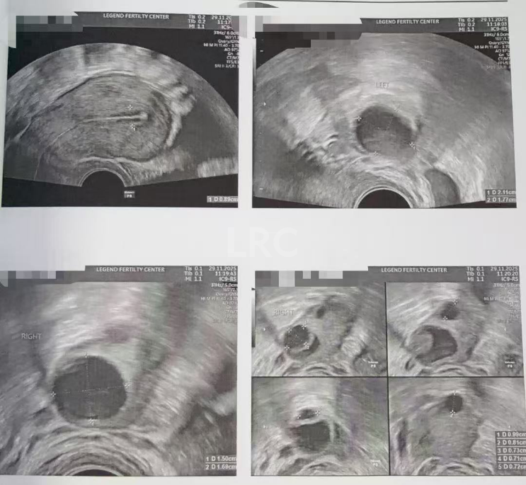 39岁卵巢差+两梯队卵泡？LRC分阶连续促排全力挽救小卵泡，6枚囊胚逆袭好孕！