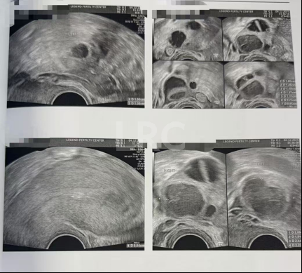 39岁卵巢差+两梯队卵泡？LRC分阶连续促排全力挽救小卵泡，6枚囊胚逆袭好孕！