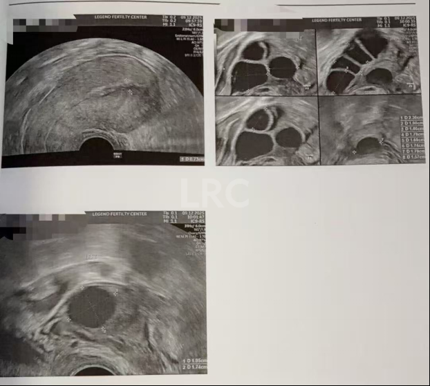 39岁卵巢差+两梯队卵泡？LRC分阶连续促排全力挽救小卵泡，6枚囊胚逆袭好孕！
