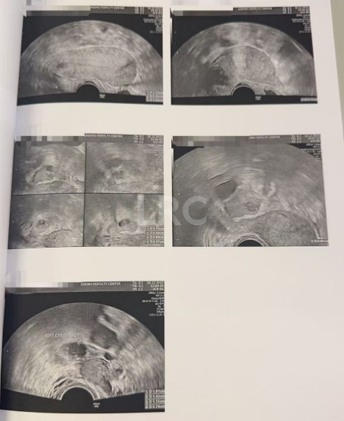 生育权不设限！35岁严重卵巢早衰，LRC针对性促排实现4取卵、全成熟，冻卵零浪费！