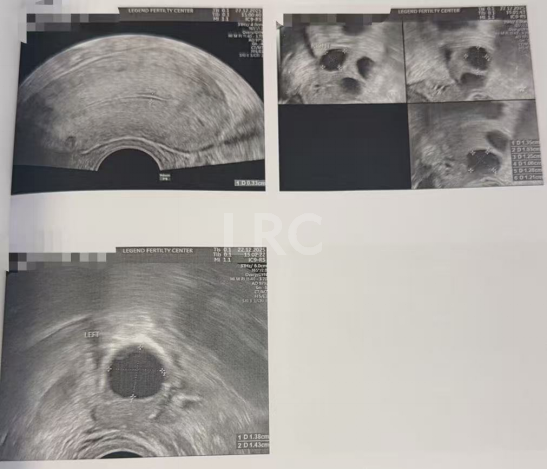 生育权不设限！35岁严重卵巢早衰，LRC针对性促排实现4取卵、全成熟，冻卵零浪费！