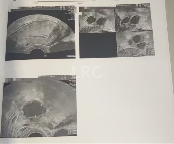 生育权不设限！35岁严重卵巢早衰，LRC针对性促排实现4取卵、全成熟，冻卵零浪费！