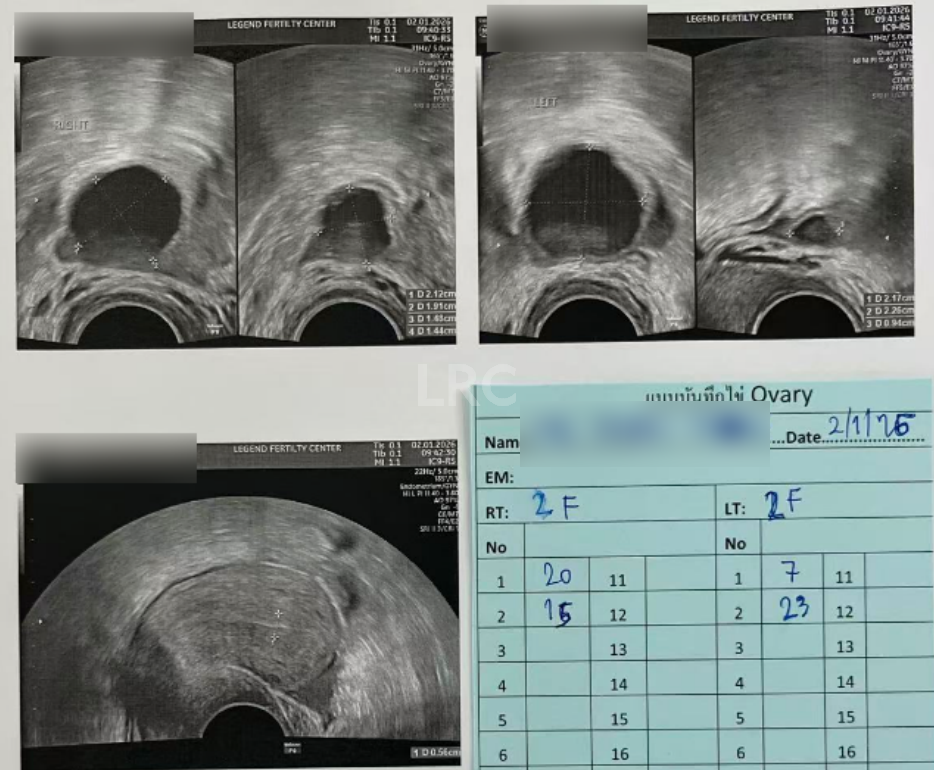 AMH0.18+高龄预警！LRC个性化温和刺激方案，开出取卵3、受精2、成囊2的好成绩~