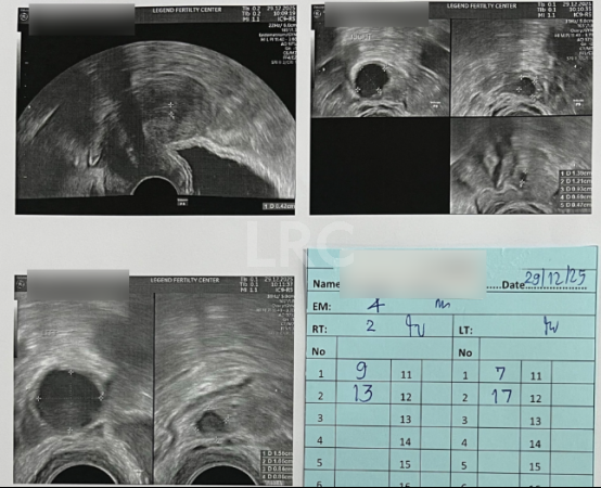 AMH0.18+高龄预警！LRC个性化温和刺激方案，开出取卵3、受精2、成囊2的好成绩~