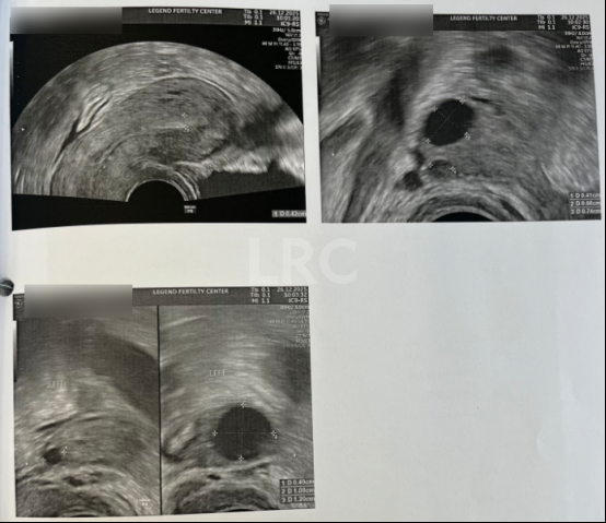 AMH0.18+高龄预警！LRC个性化温和刺激方案，开出取卵3、受精2、成囊2的好成绩~