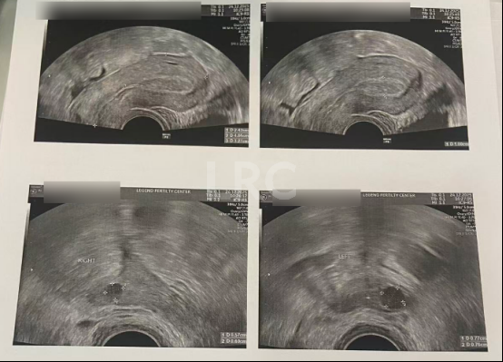 AMH0.18+高龄预警！LRC个性化温和刺激方案，开出取卵3、受精2、成囊2的好成绩~
