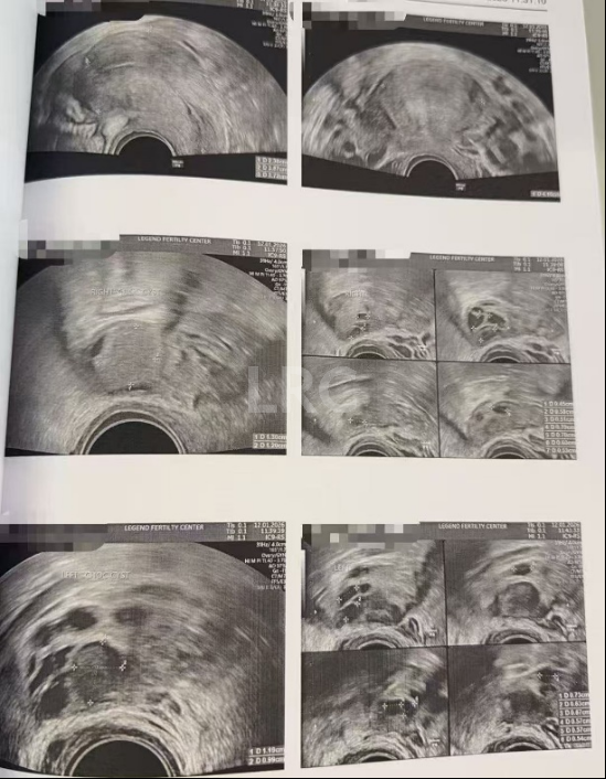 双侧巧囊+男方精子差？LRC个性化诊疗，取20卵成囊11颗，好孕破局~