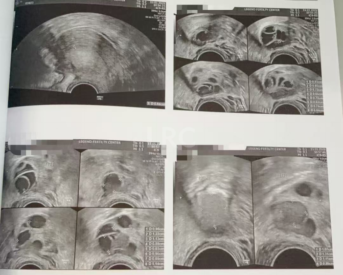 双侧巧囊+男方精子差？LRC个性化诊疗，取20卵成囊11颗，好孕破局~