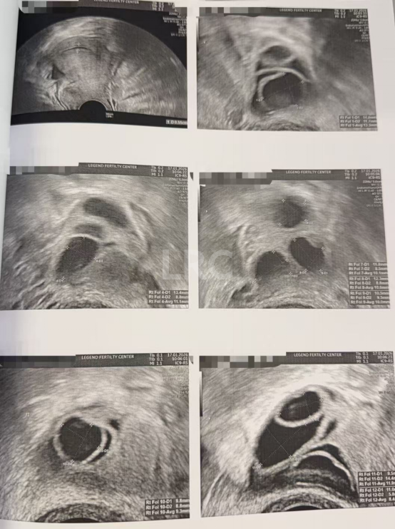 双侧巧囊+男方精子差？LRC个性化诊疗，取20卵成囊11颗，好孕破局~