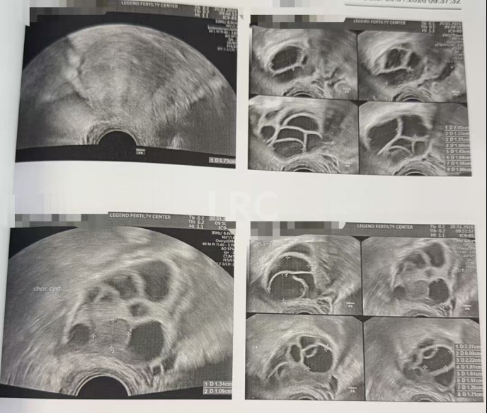 双侧巧囊+男方精子差？LRC个性化诊疗，取20卵成囊11颗，好孕破局~