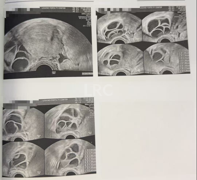 双侧巧囊+男方精子差？LRC个性化诊疗，取20卵成囊11颗，好孕破局~