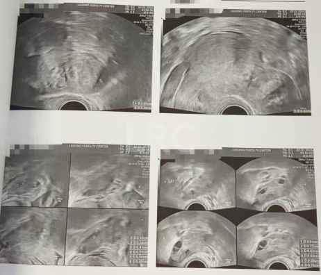 43+47双高龄暴击！LRC个性化促排实现解锁高成囊率，取卵10→受精8→成囊6！