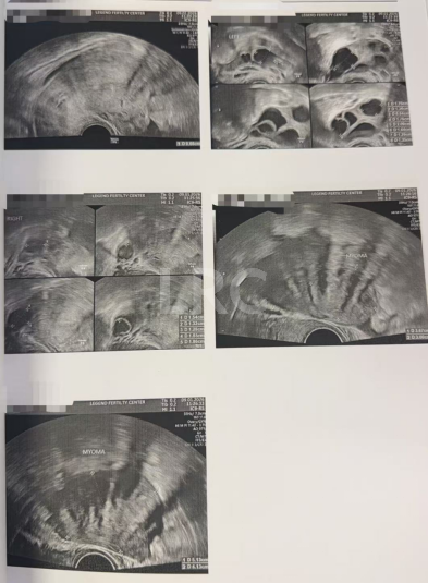 43+47双高龄暴击！LRC个性化促排实现解锁高成囊率，取卵10→受精8→成囊6！