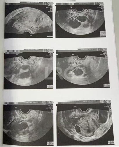 43+47双高龄暴击！LRC个性化促排实现解锁高成囊率，取卵10→受精8→成囊6！