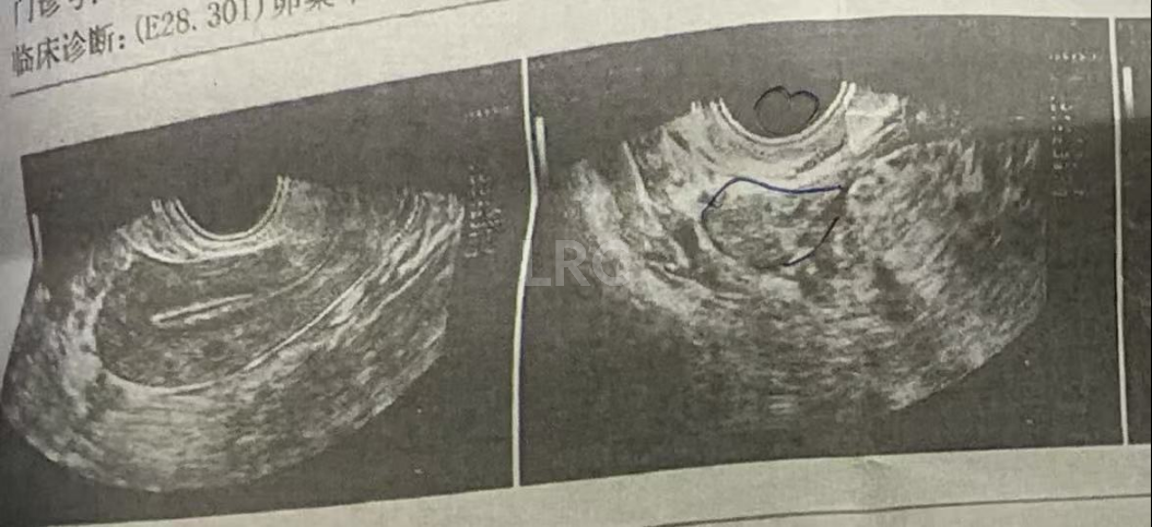 37岁卵巢衰退遇上精子质量差，LRC温和刺激方案，仅取卵3颗，就养成2枚囊胚！