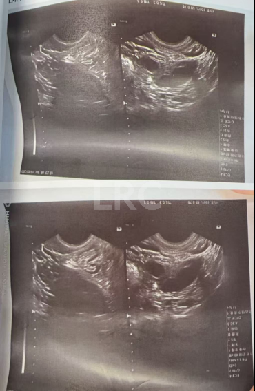 37岁卵泡不均难促排，LRC精准促排实现受精养囊双百，拿下10颗囊胚！