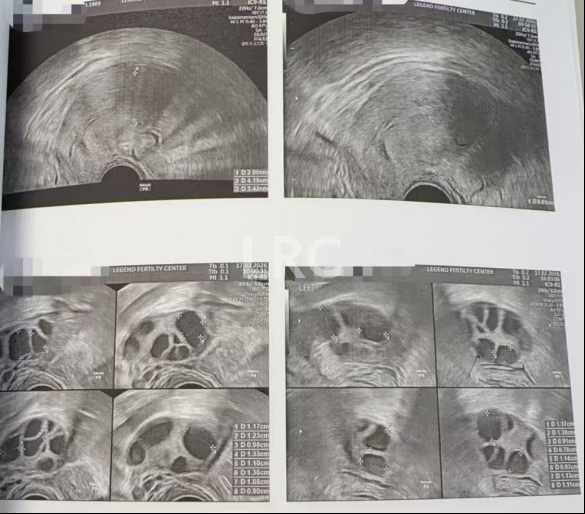 37岁卵泡不均难促排，LRC精准促排实现受精养囊双百，拿下10颗囊胚！