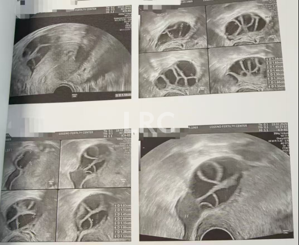 37岁卵泡不均难促排，LRC精准促排实现受精养囊双百，拿下10颗囊胚！