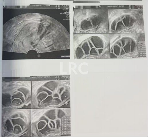 37岁卵泡不均难促排，LRC精准促排实现受精养囊双百，拿下10颗囊胚！