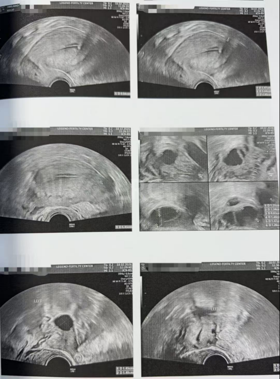 40岁卵泡不均+47岁精子双低！LRC用个性化促排盘活稀缺卵泡，4颗胚胎全成囊！