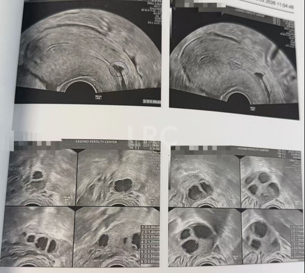 38岁卵巢反应不良、卵泡停滞，LRC精准调理促排+硬核养囊，5枚受精卵全成囊，稳拿健康胚！