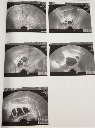 28岁卵巢早衰，卵泡大小乱成一团，LRC个性化促排全程监测，最终5颗受精卵全部成囊！