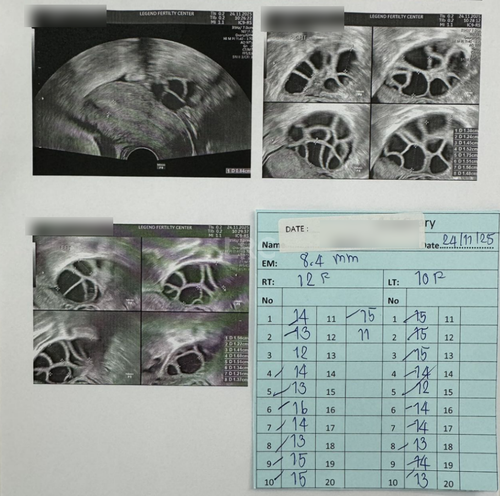 男方69岁重度弱精翻盘！LRC DGC高密梯度离心法+个性化促排方案，6周见胎心