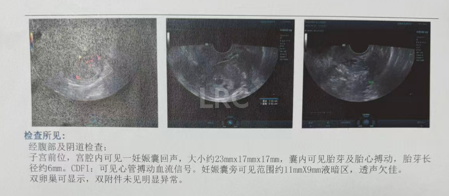 男方69岁重度弱精翻盘！LRC DGC高密梯度离心法+个性化促排方案，6周见胎心